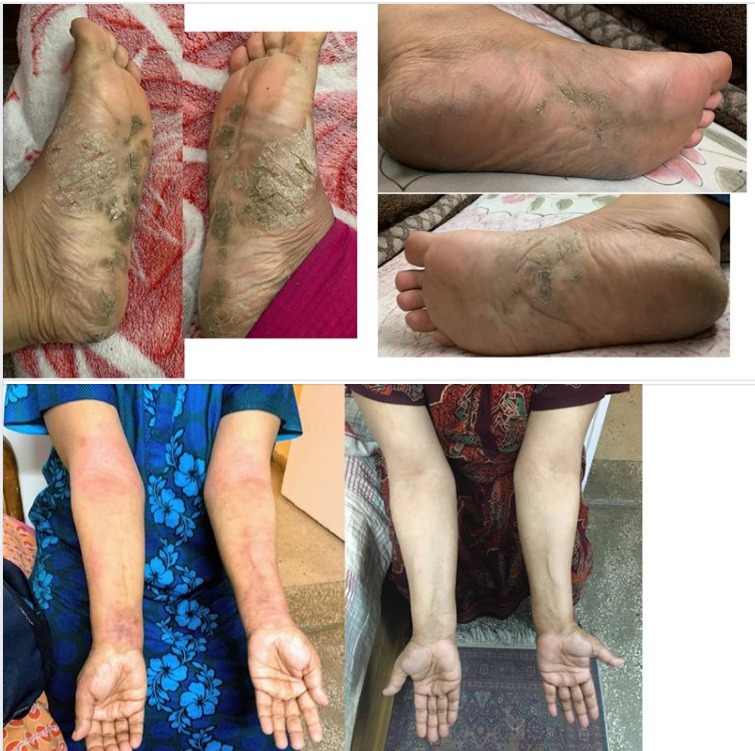 Hope for Psoriasis (and possibly other skins issues e.g. Vitiligo/Leucoderma, Eczema etc)?